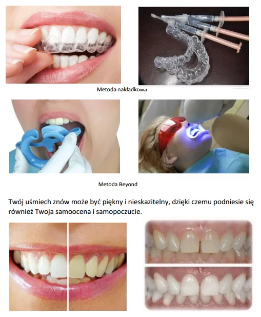 wybielanie2_1490188425